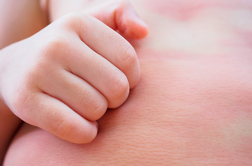 Dermatita de contact simptome